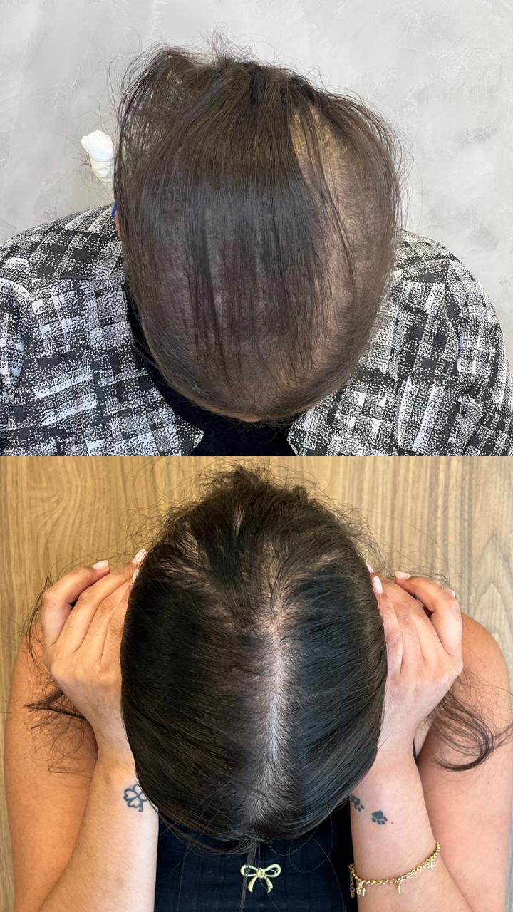 Resultado de tratamento capilar — recuperação de densidade no topo da cabeça