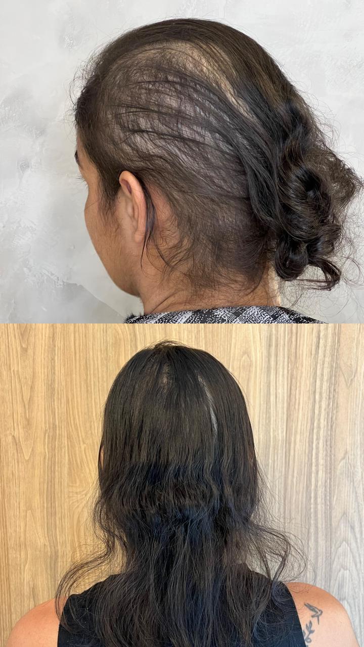 Resultado de tratamento capilar — recuperação completa de volume