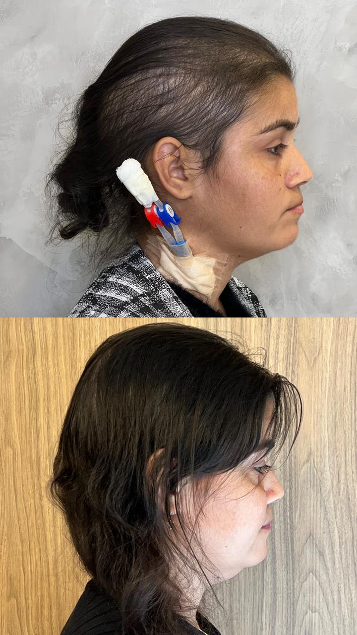 Resultado de tratamento capilar — crescimento de novos fios