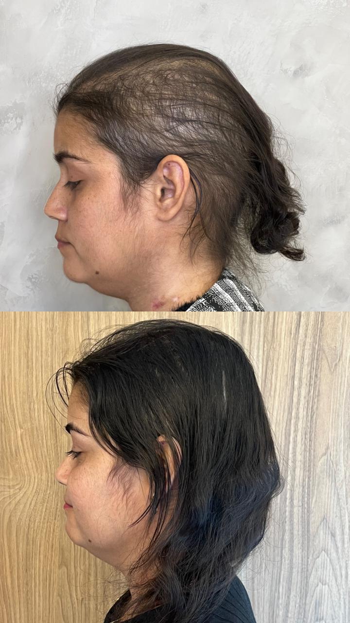 Resultado de tratamento capilar — recuperação lateral