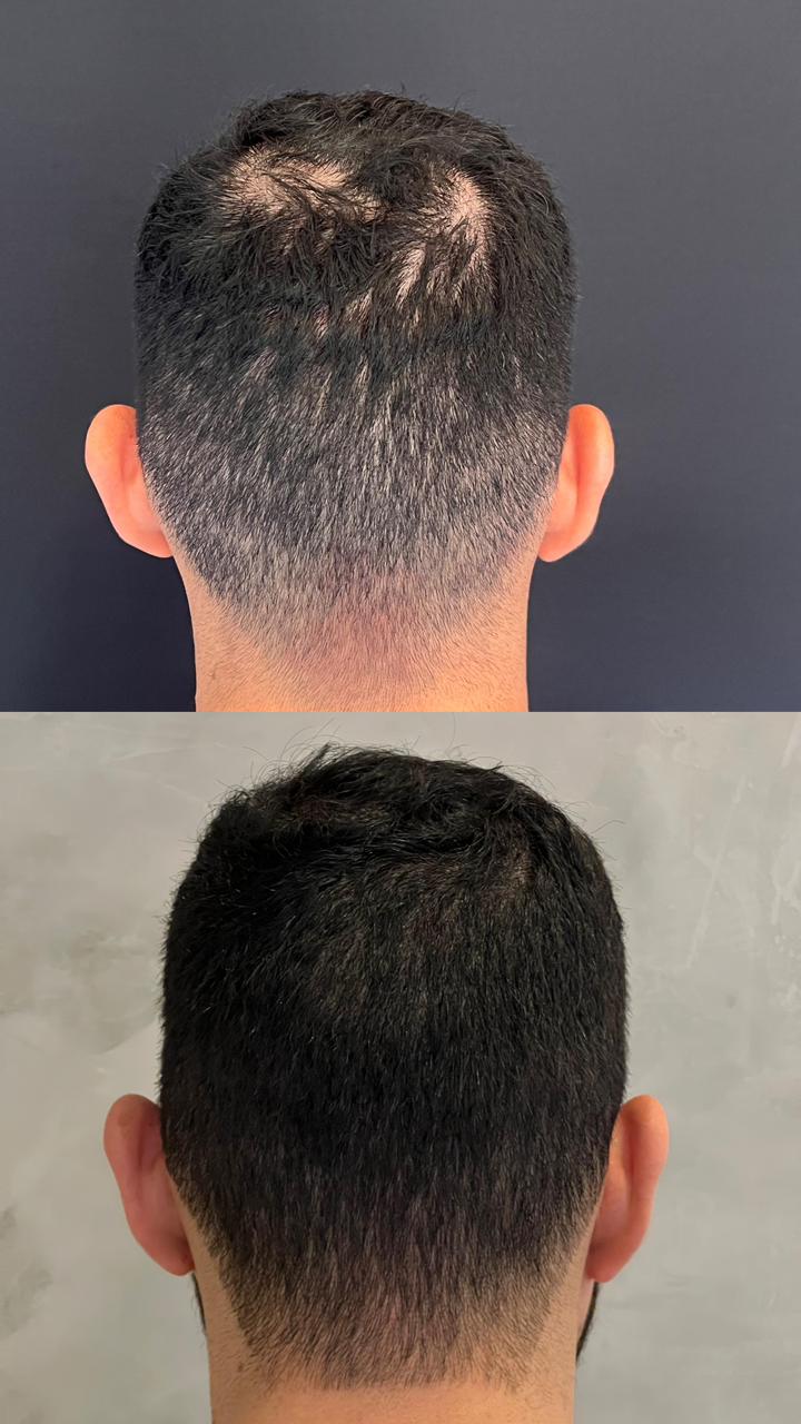 Resultado de tratamento capilar masculino — recuperação da coroa