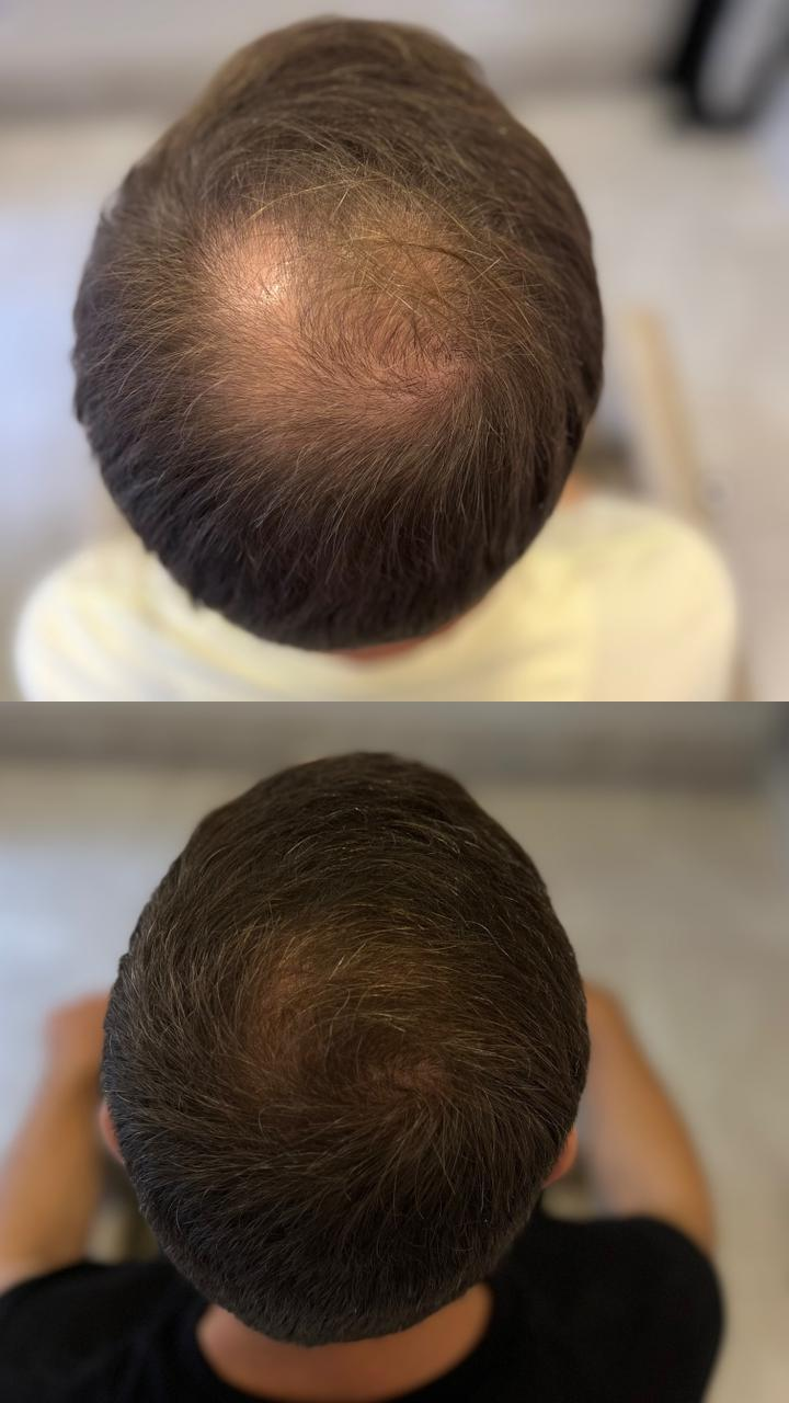 Resultado de tratamento capilar masculino — recuperação de densidade no topo