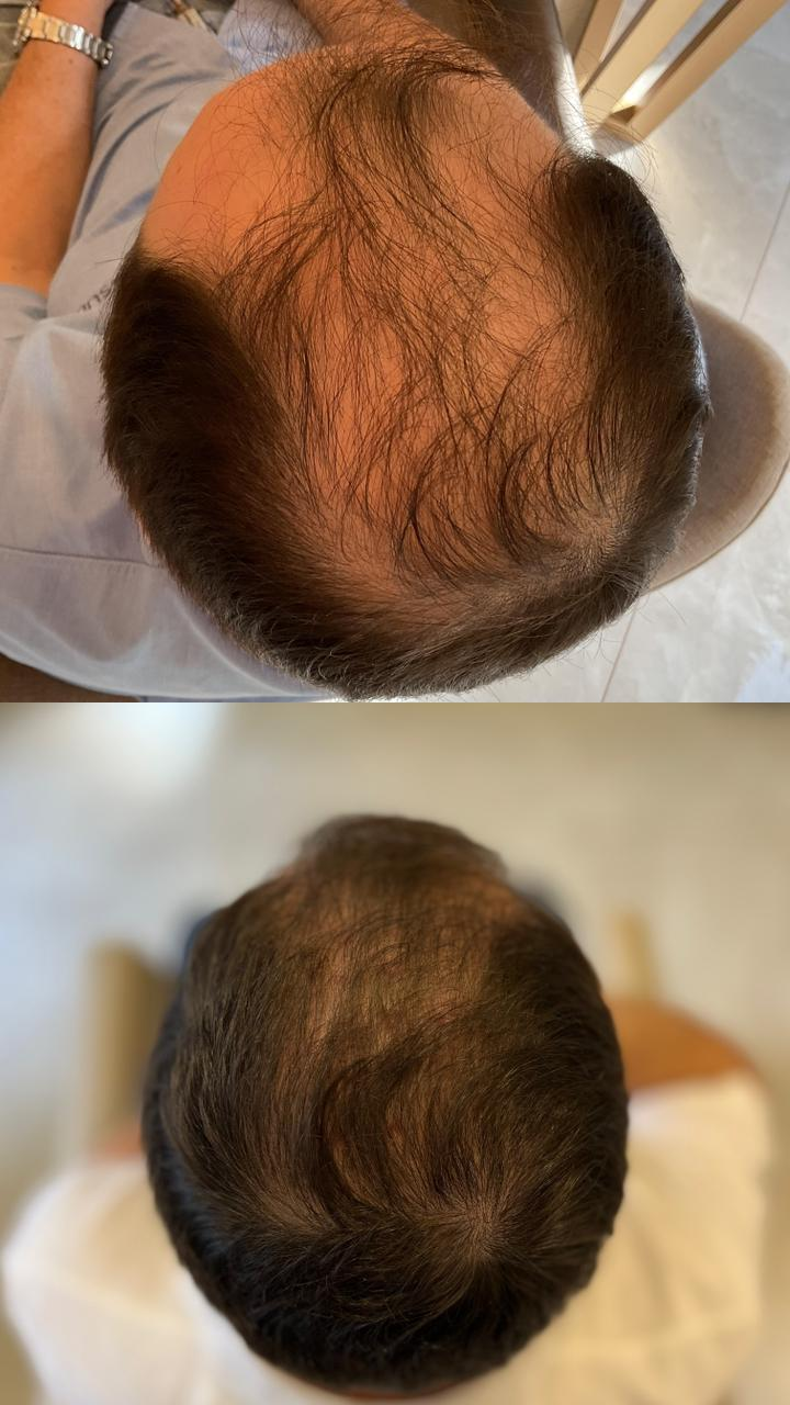 Resultado de tratamento capilar masculino — cobertura de área calva