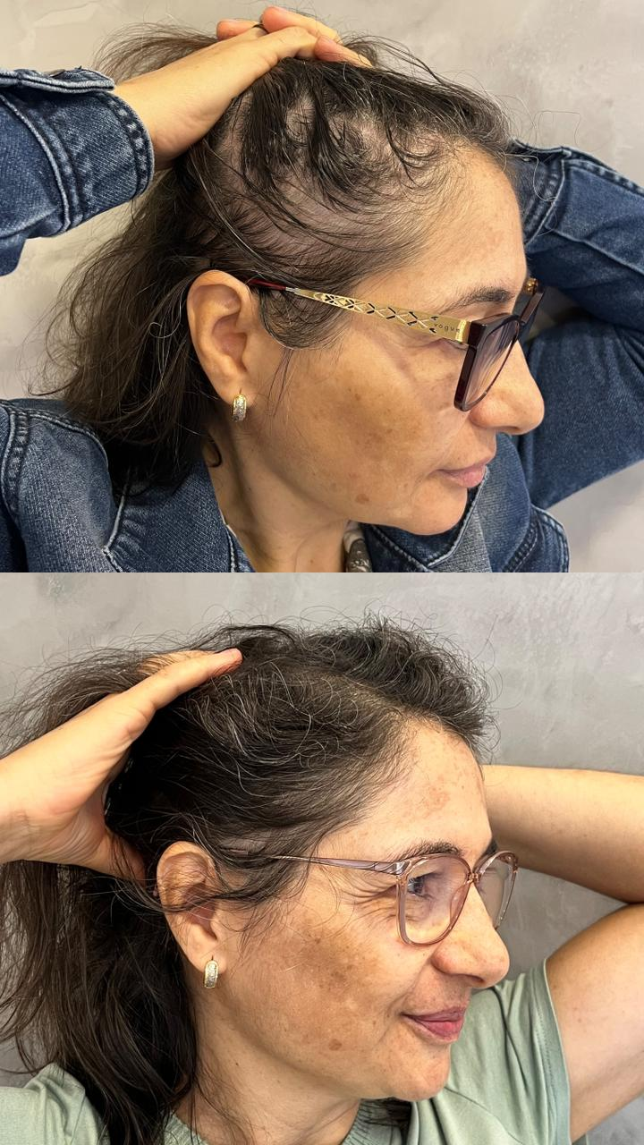 Resultado de tratamento capilar feminino — recuperação de volume na região temporal